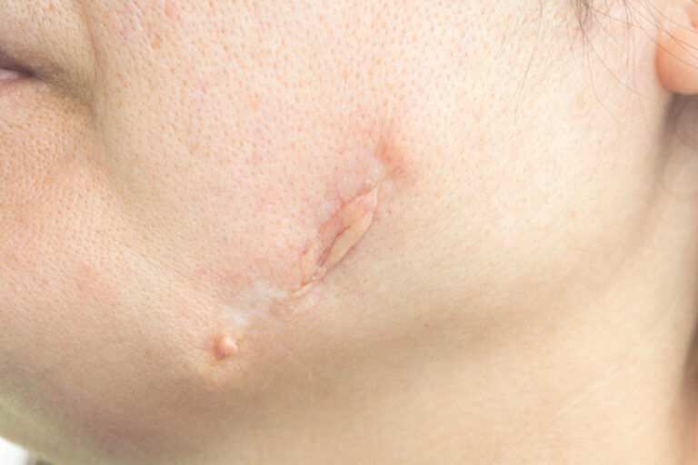 big scar face