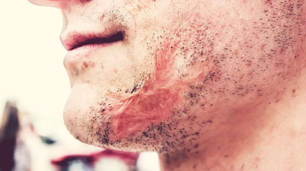 facial_scarring