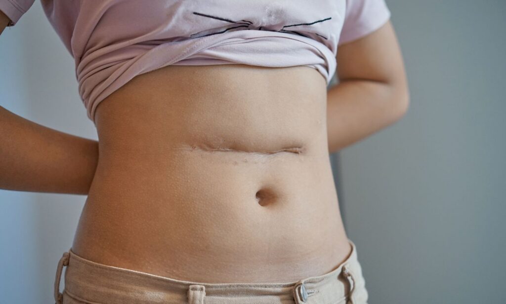 scars tummy