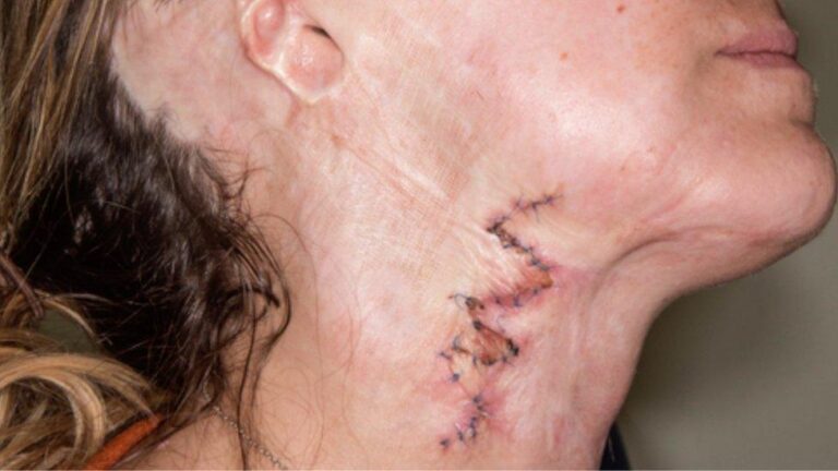 acid attack